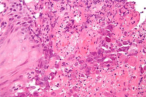Herpes esophagitis - very high mag.jpg