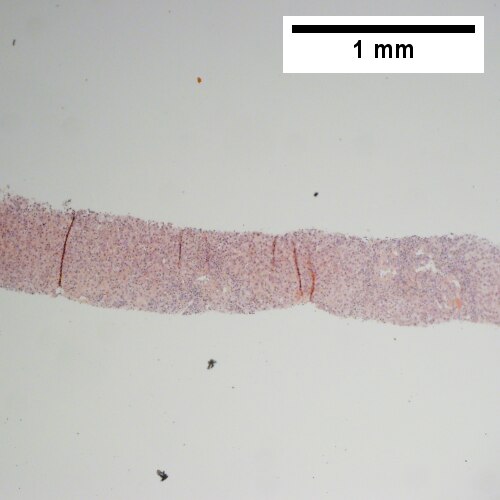 Low power shows inflammation; portal triads, lobules, central veins cannot be distinguished (40X).