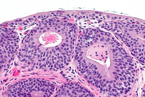Cystitis cystica - alt -- high mag.jpg