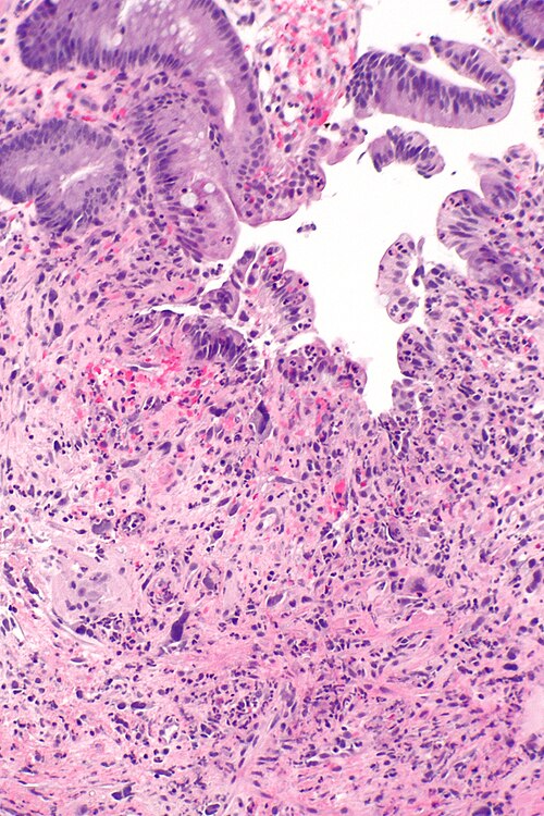 Radiation proctitis -- intermed mag.jpg
