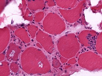 IBM rimmed vacuoles HE x200.jpg