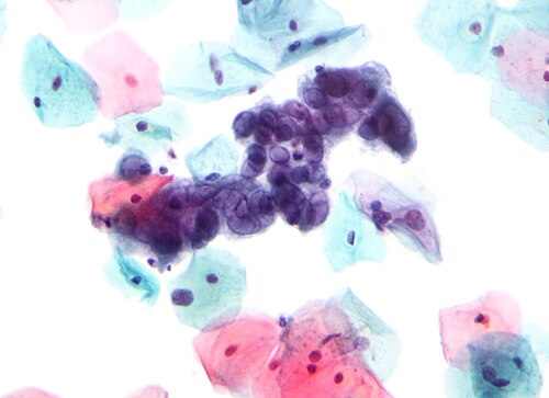 Herpes simplex virus pap test 2.jpg