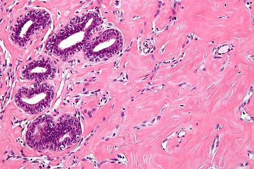 Pseudoangiomatous stromal hyperplasia -a- high mag.jpg