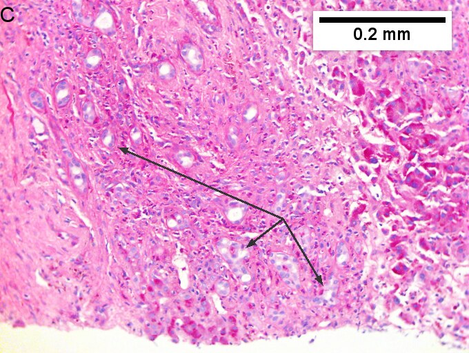 Cholangiocarcinoma with associated abscess