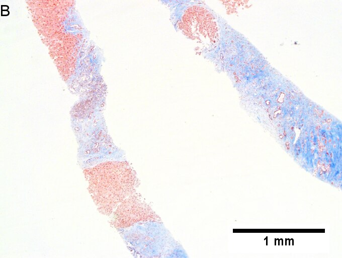 Alpha 1 anti-trypsin (A1AT) granules in cirrhosis, not due to A1AT deficiency; A1AT level was normal.