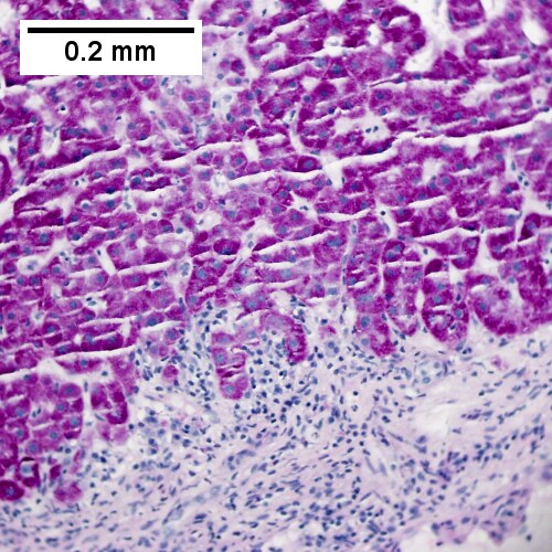 PAS without diastase shows interface hepatitis (200X).