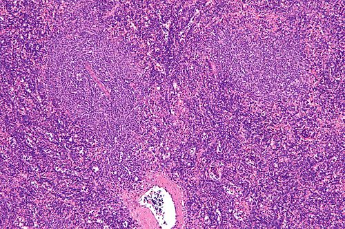 Chronic lymphocytic leukemia - intermed mag.jpg