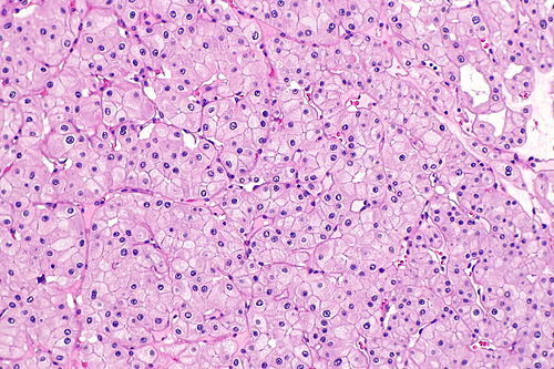 Eosinophilic variant of chromophobe renal cell carcinoma -- intermed mag.jpg