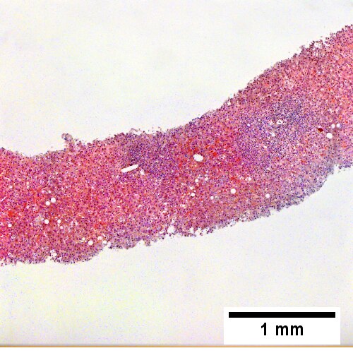 Expanded, inflamed triads with increased bile duct/vascular openings. Mild steatosis (40X).