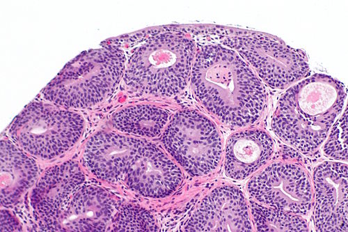 Cystitis cystica - alt -- intermed mag.jpg