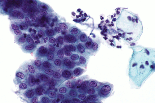 Squamous reactive changes - Pap -- very high mag.gif
