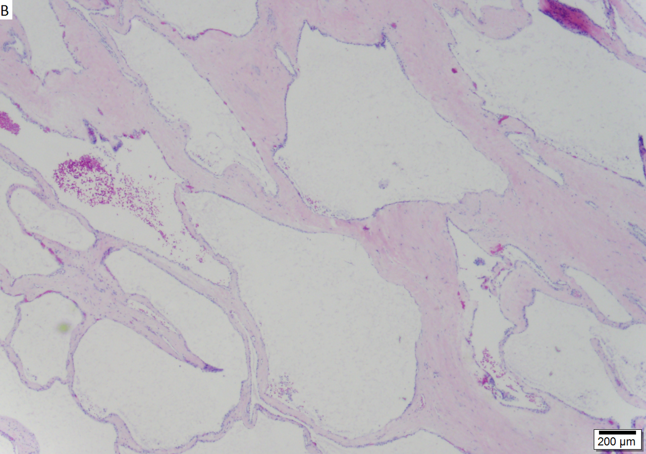 Microcystic serous cystadenoma of pancreas