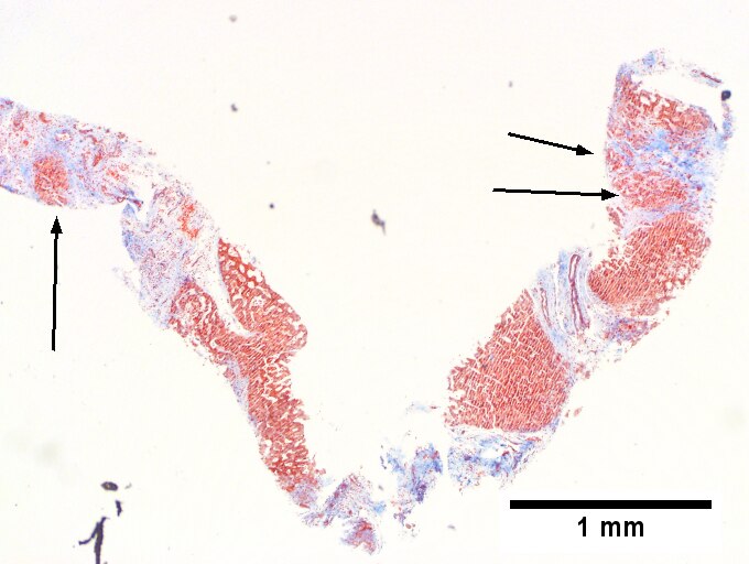 Cirrhosis in an alcoholic.