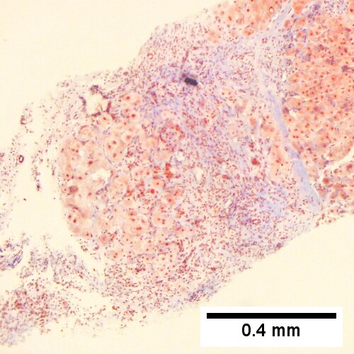 Alpha 1 Antitrypsin deficiency with cirrhosis