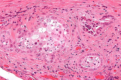 Vasitis nodosa -21- very high mag.jpg