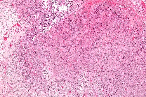 Epithelioid sarcoma - low mag.jpg