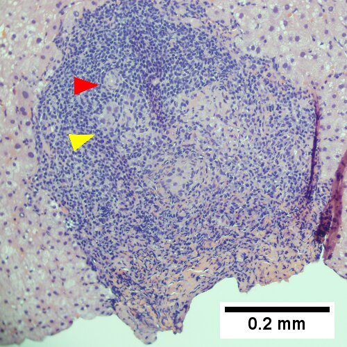 A triad bears a poorly formed granuloma [yellow arrowhead]. A bile duct is also seen [red arrowhead] (200X).