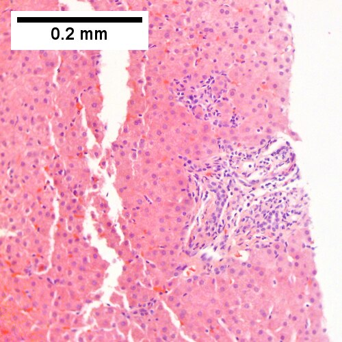 Hepatitis C virus. Metavir Activity Index 1 (PMN 0 LN 1).