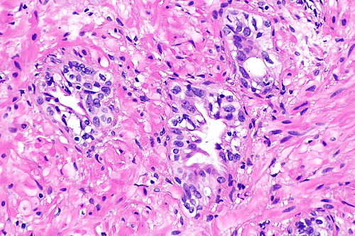 Prostate with radiation changes -- high mag.jpg