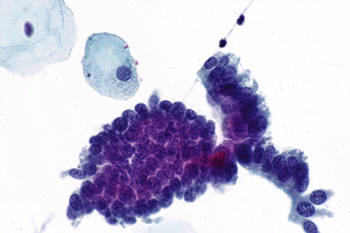 Endocervical adenocarcinoma in situ - cyto -- very high mag.gif