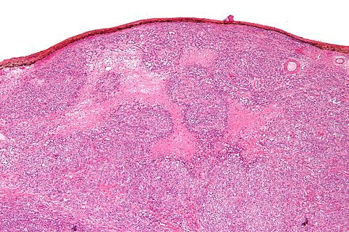 Small cell carcinoma of the ovary hypercalcemic type - low mag.jpg