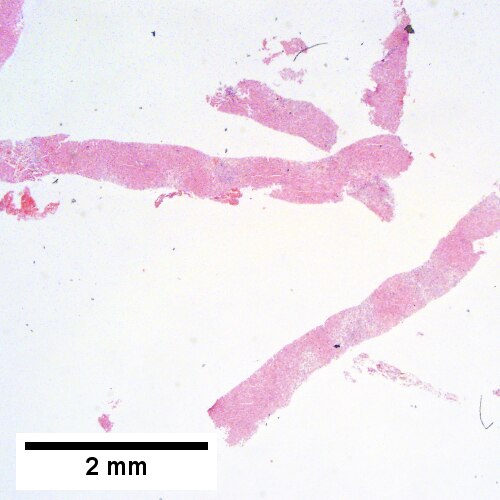 Submassive hepatic necrosis.