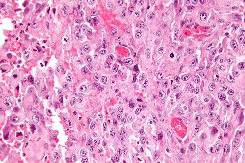 Epithelioid sarcoma - very high mag.jpg