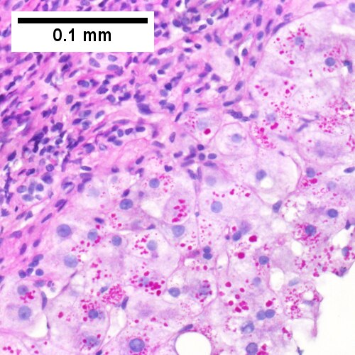 Alpha 1 Antitrypsin deficiency with cirrhosis