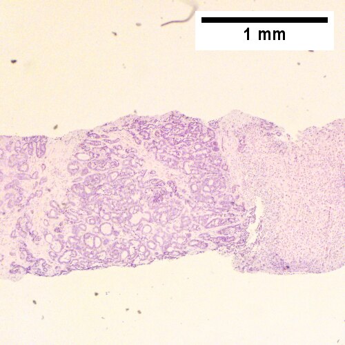 Cholangiocarcinoma, intrahepatic, large duct type.