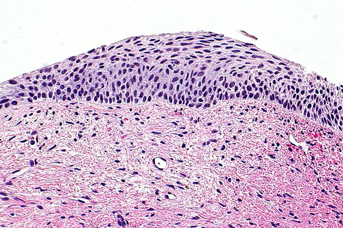 Atrophic cervix - 2 -- high mag.jpg