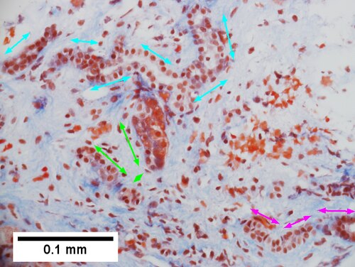 Cirrhosis in an alcoholic.