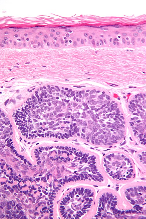 Dermal cylindroma high mag.jpg