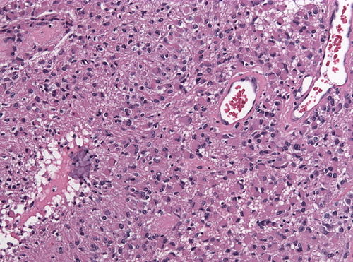 Neuropathology case IX 02.jpg