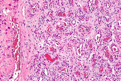 Chorangioma - high mag.jpg