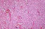 Oligodendroglioma1 low mag.jpg