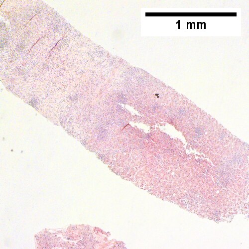 Apparent inflamed fibrous tract with lobular inflammatory collections in adjacent liver (Row 1 Left 40X).