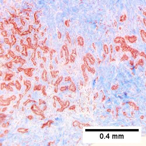 Cholangiocarcinoma, intrahepatic, large duct type.