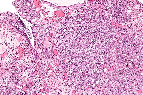 Nephrogenic adenoma - intermed mag.jpg