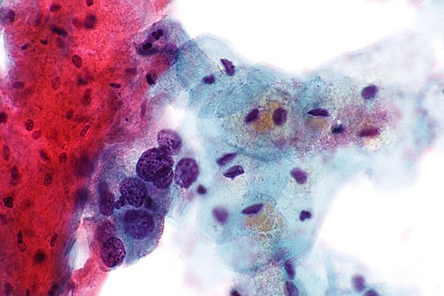 High-grade squamous intraepithelial lesion - 3 -- very high mag.jpg
