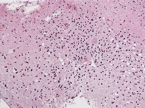 Neuropathology case DOLN HE II.jpg