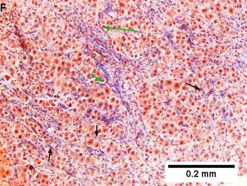 Drug induced liver injury in a young adult man