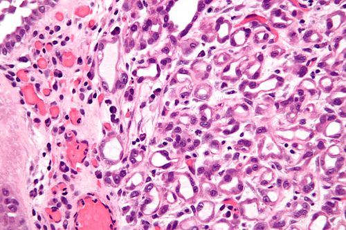 Nephrogenic adenoma - very high mag.jpg