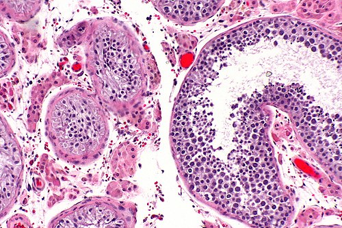 Atrophic changes of the testis -- intermed mag.jpg