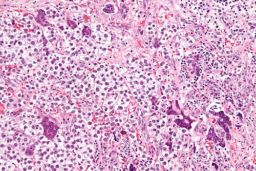 Seminoma with syncytiotrophoblasts - high mag.jpg