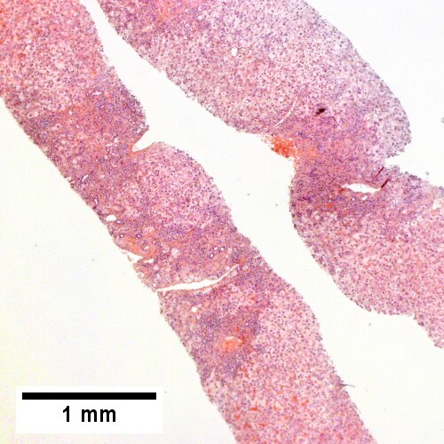 Expanded inflamed portal triads, swollen hepatocytes (40X)