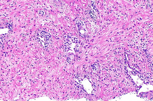 Prostate with radiation changes -- intermed mag.jpg