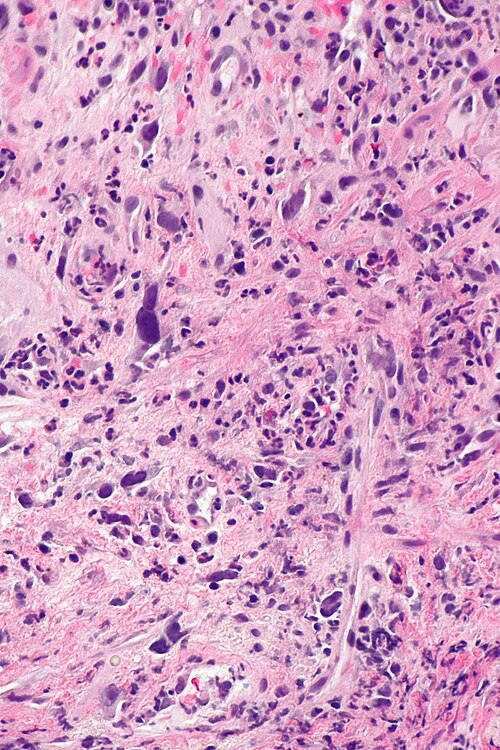 Radiation proctitis -- high mag.jpg