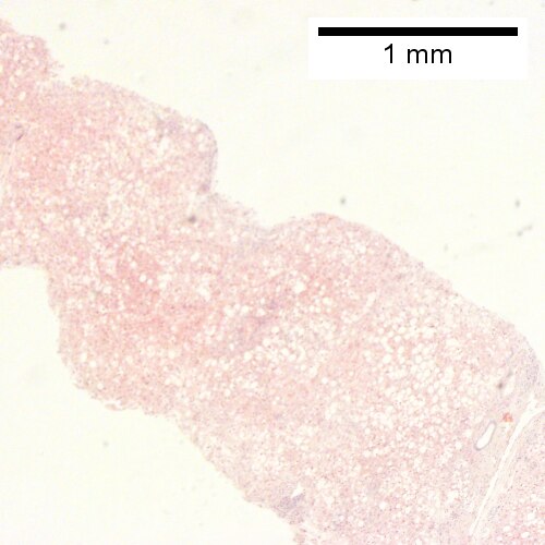 Panacinar steatosis with unremarkable, small triads (40X).