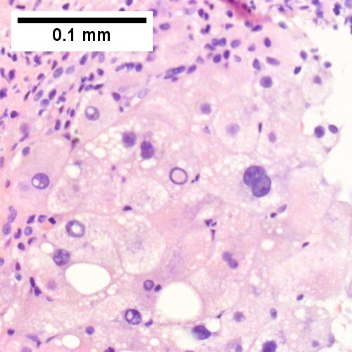 Alpha 1 Antitrypsin deficiency with cirrhosis