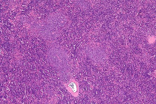Chronic lymphocytic leukemia - low mag.jpg